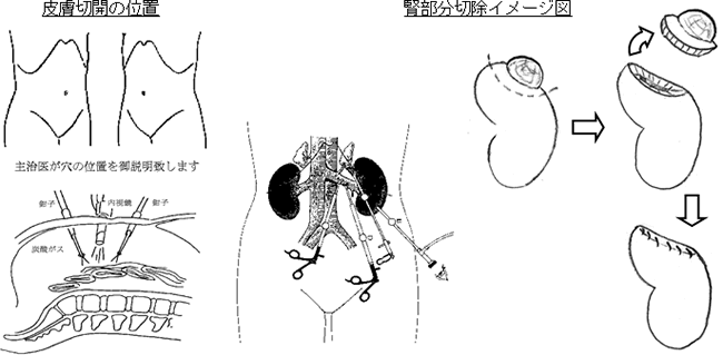 看護 下 摘出 腹腔 術 胆嚢 鏡 腹腔鏡下胆のう摘出術（ラパコレ）の術式について