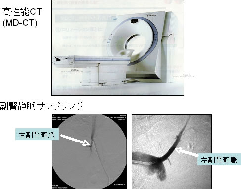 症 原発 芸能人 アルドステロン 性 内科受診～原発性アルドステロン症の疑い～検査入院