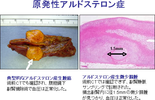 原発 性 アルドステロン 症 しんどい